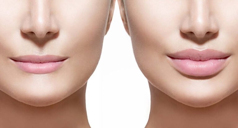 What is the Recovery Process after Lip Filler Treatment?